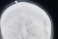 Bukan Kuntilanak! Kepala Perempuan Ini Ditusuk Paku Agar Lahirkan Bayi Laki-laki. Foto: BBC