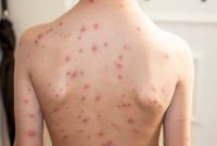 Penyakit cacar monyet. Foto: Istimewa