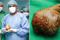 Batu ginjal terbesar di dunia. Foto: Guinness World Records