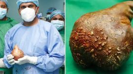 Batu ginjal terbesar di dunia. Foto: Guinness World Records