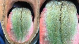 Seorang pria asal negara bagian Ohio, Amerika Serikat mengalami kondisi yang mengerikan. Lidah pria tersebut ditumbuhi bulu dan berubah warna menjadi hijau. Hal ini disebabkan karena kebiasaan merokok dan meminum antibiotik. Foto: Istimewa 