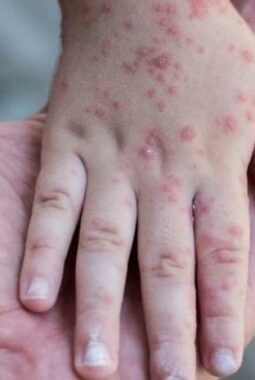493 Kasus Flu Singapura, Batam Belum Terapkan Pembatasan Wisatawan